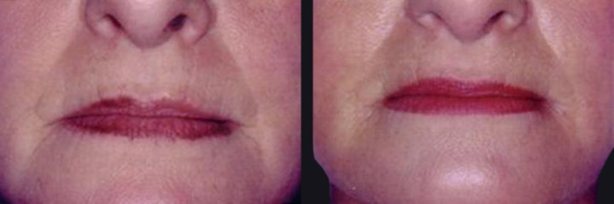 Microneedling Before & After Gallery - Patient 177928292 - Image 1