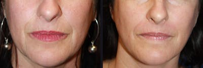 Microneedling Before & After Gallery - Patient 177928291 - Image 1