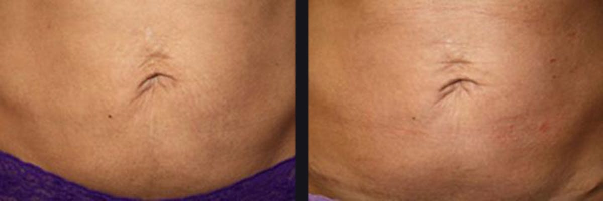 Microneedling Before & After Gallery - Patient 177928290 - Image 1