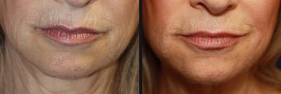 Microneedling Before & After Gallery - Patient 177928289 - Image 1