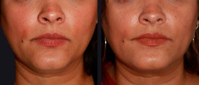 Dermal Fillers Before & After Gallery - Patient 177928288 - Image 1