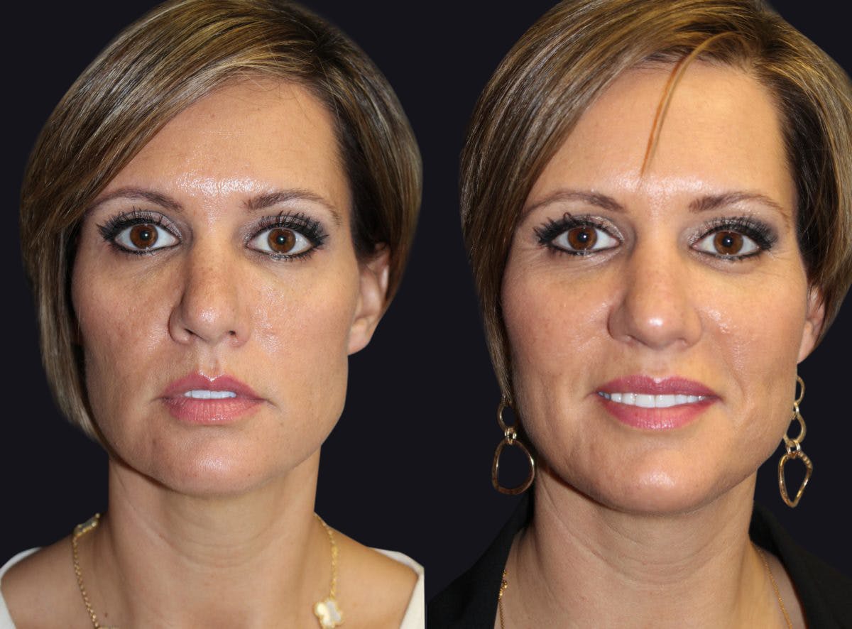 Dermal Fillers Before & After Gallery - Patient 177928287 - Image 1