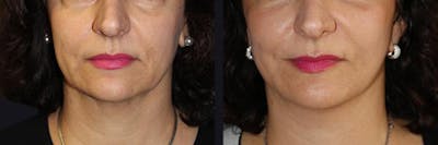 Dermal Fillers Before & After Gallery - Patient 177928267 - Image 1
