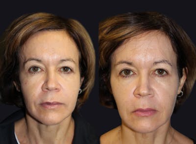 Dermal Fillers Before & After Gallery - Patient 177928238 - Image 1