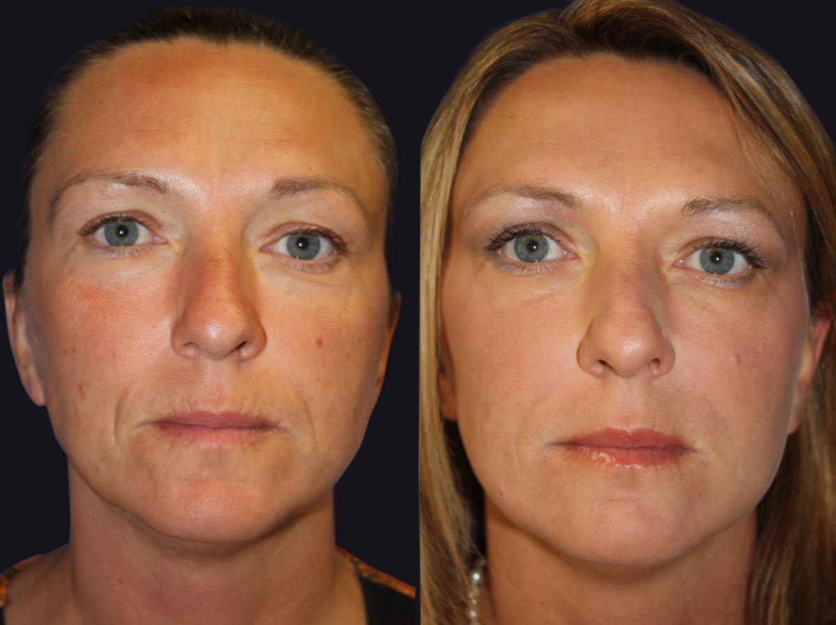 Dermal Fillers Before & After Gallery - Patient 177928218 - Image 1
