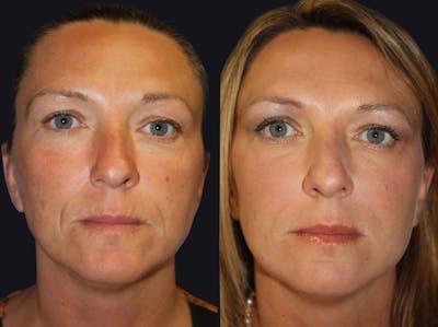 Dermal Fillers Before & After Gallery - Patient 177928218 - Image 1
