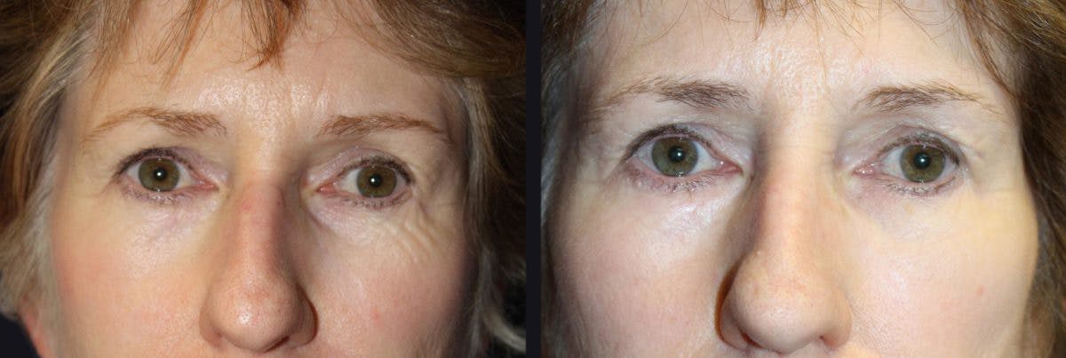 Botox Before & After Gallery - Patient 177927891 - Image 1