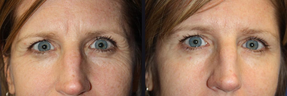 Botox Before & After Gallery - Patient 177927814 - Image 1