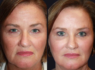 Chemical Peel Before & After Gallery - Patient 177927757 - Image 1