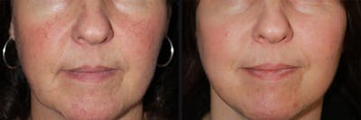 Chemical Peel Before & After Gallery - Patient 177927752 - Image 1
