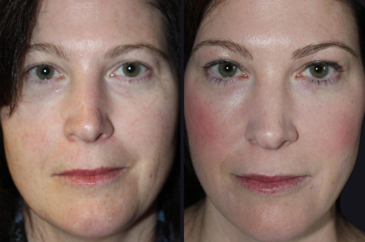 Chemical Peel Before & After Gallery - Patient 177927750 - Image 1
