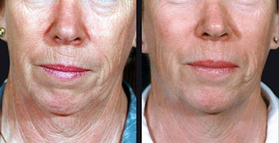 Skin Product Rejuvenation Before & After Gallery - Patient 177927749 - Image 1