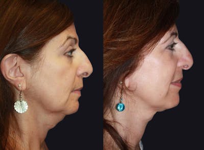 Chemical Peel Before & After Gallery - Patient 177927748 - Image 1