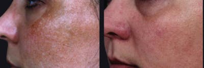 Skin Product Rejuvenation Before & After Gallery - Patient 177927747 - Image 1