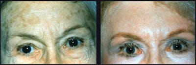 Chemical Peel Before & After Gallery - Patient 177927746 - Image 1