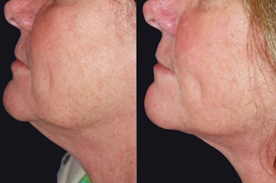 Skin Tightening Before & After Gallery - Patient 177927745 - Image 1