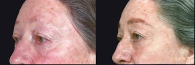 Skin Product Rejuvenation Before & After Gallery - Patient 177927744 - Image 1