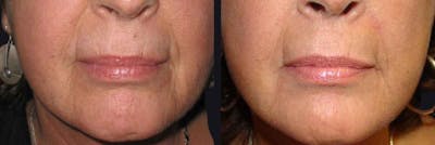Chemical Peel Before & After Gallery - Patient 177927741 - Image 1