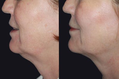 Skin Tightening Before & After Gallery - Patient 177927740 - Image 1