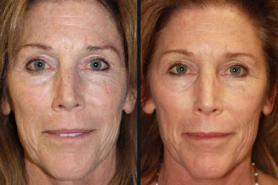 Chemical Peel Before & After Gallery - Patient 177927738 - Image 1