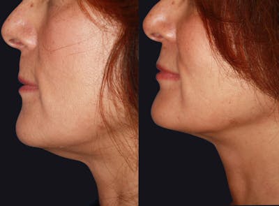 Skin Tightening Before & After Gallery - Patient 177927737 - Image 1