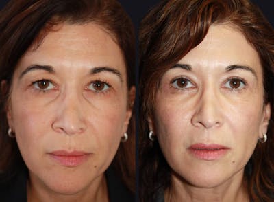 Chemical Peel Before & After Gallery - Patient 177927735 - Image 1