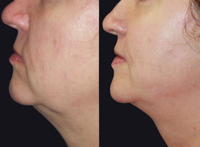 Skin Tightening Before & After Gallery - Patient 177927734 - Image 1