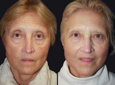 Medical Facials Before & After Gallery - Patient 177927733 - Image 1