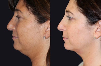 Skin Tightening Before & After Gallery - Patient 177927732 - Image 1