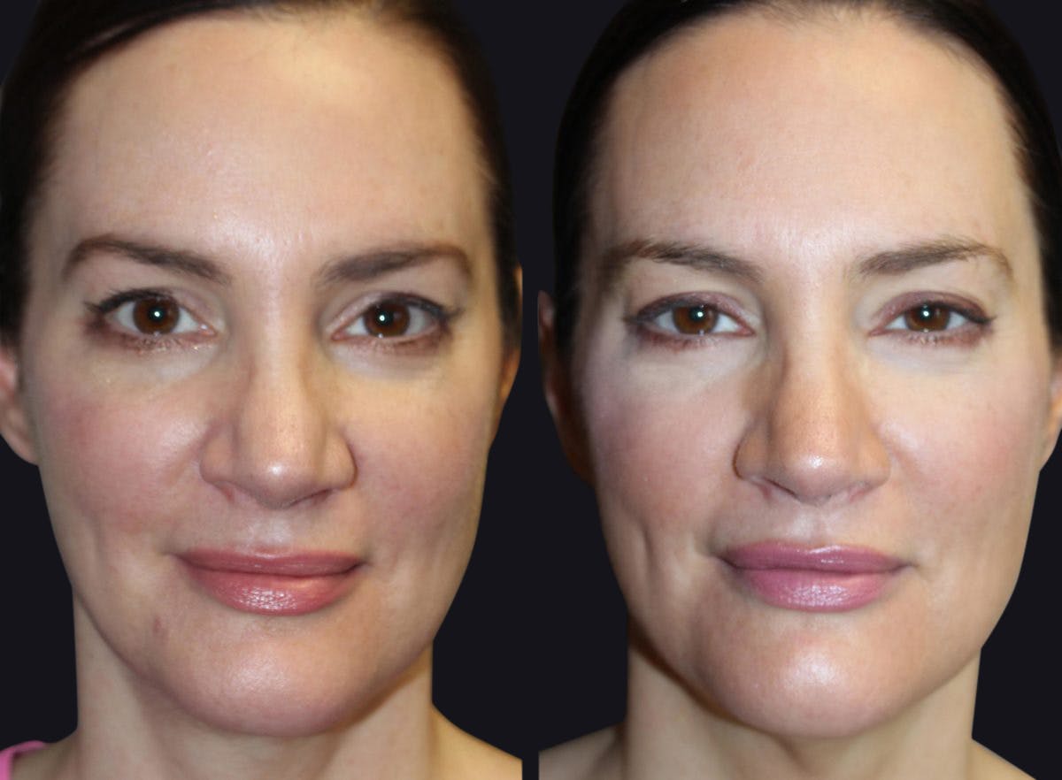Medical Facials Before & After Gallery - Patient 177927731 - Image 1