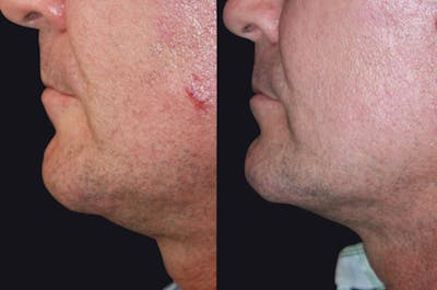 Skin Tightening Before & After Gallery - Patient 177927730 - Image 1