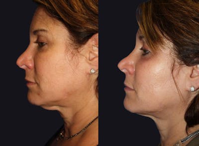 Skin Tightening Before & After Gallery - Patient 177927729 - Image 1