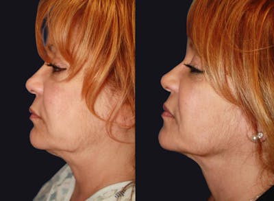 Skin Tightening Before & After Gallery - Patient 177927726 - Image 1