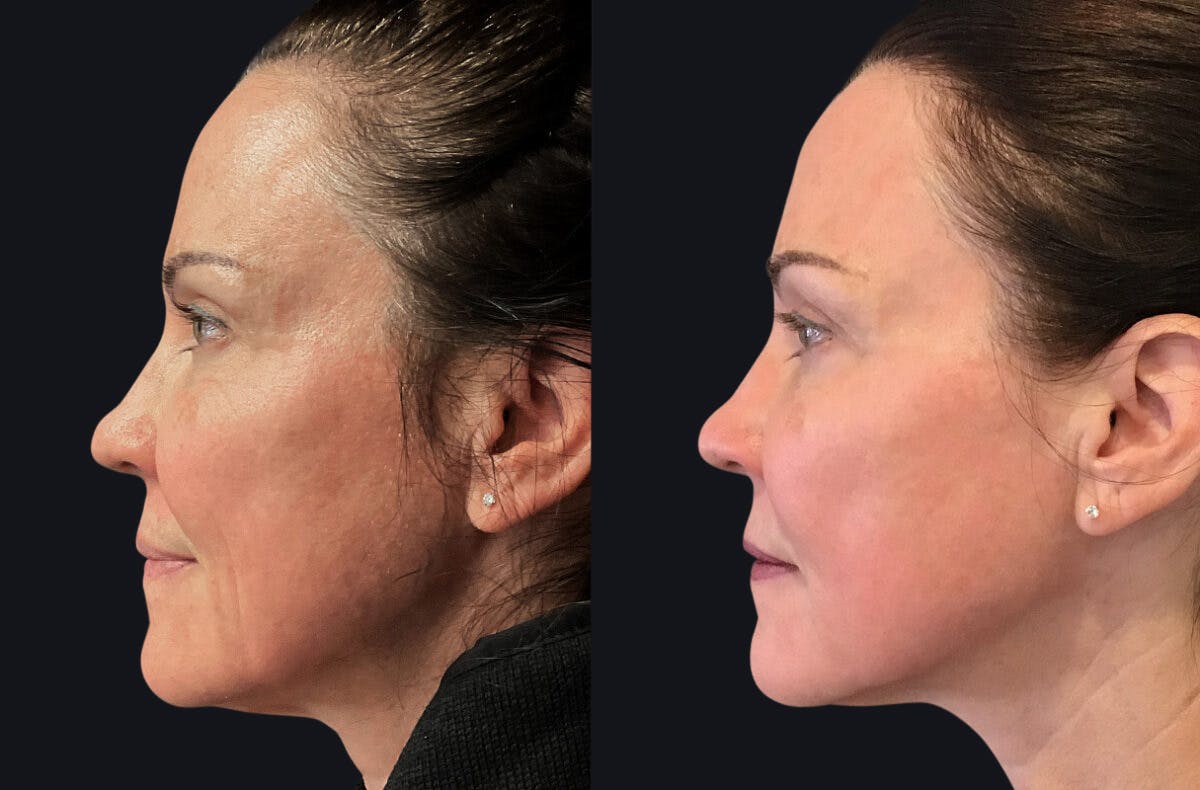 CO2 Laser Resurfacing Before & After Gallery - Patient 177927725 - Image 2