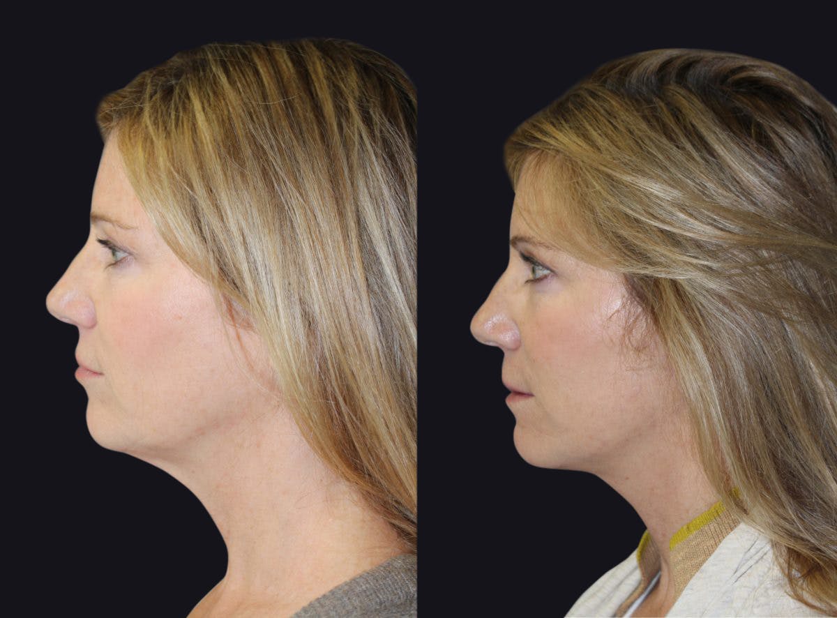 Skin Tightening Before & After Gallery - Patient 177927724 - Image 2