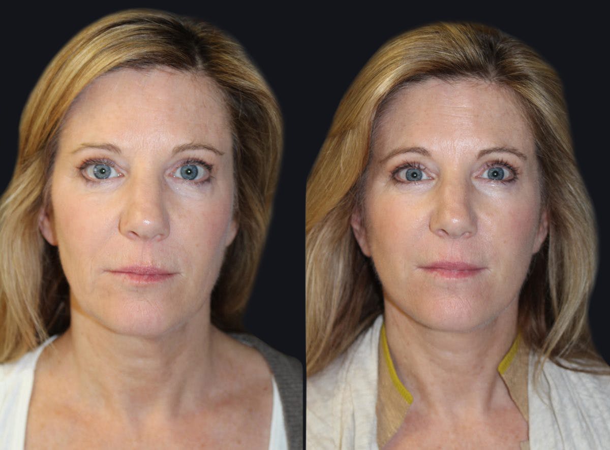 Skin Tightening Before & After Gallery - Patient 177927724 - Image 1