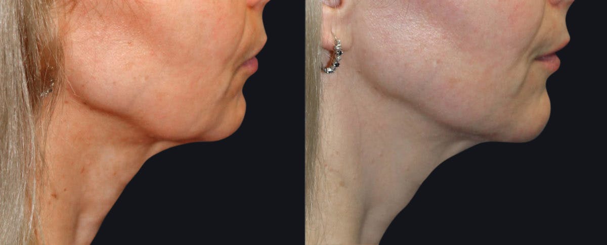 Skin Tightening Before & After Gallery - Patient 177927723 - Image 2