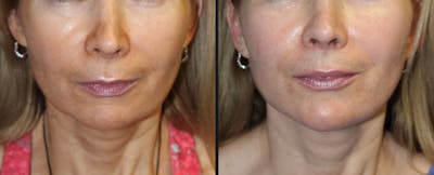 Skin Tightening Before & After Gallery - Patient 177927723 - Image 1
