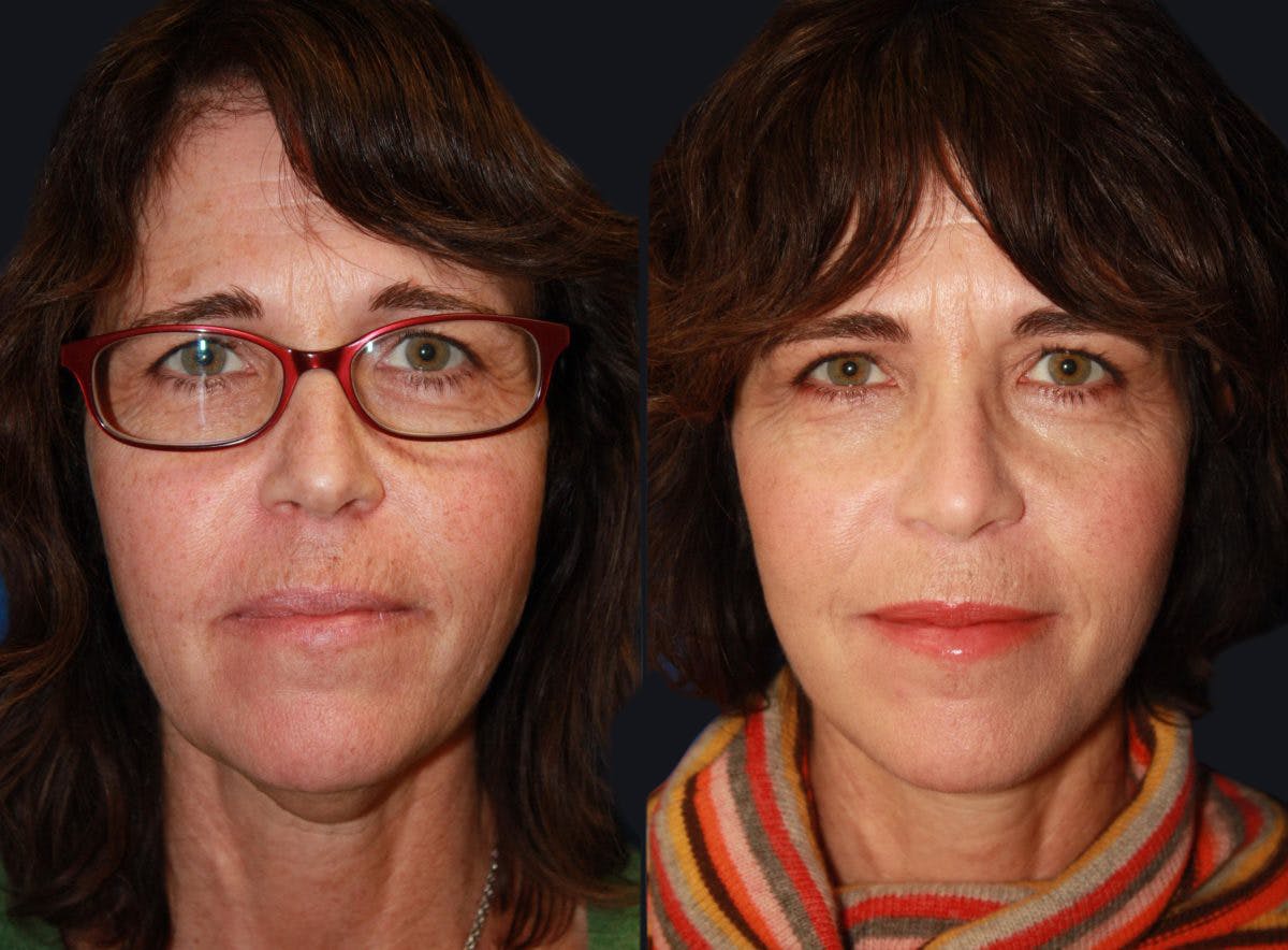 Laser Skin Rejuvenation Before & After Gallery - Patient 177906192 - Image 1