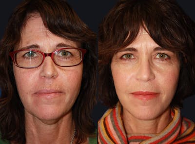 Laser Skin Rejuvenation Before & After Gallery - Patient 177906192 - Image 1
