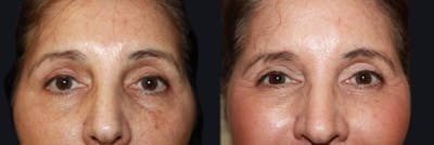 Laser Skin Rejuvenation Before & After Gallery - Patient 177905998 - Image 1