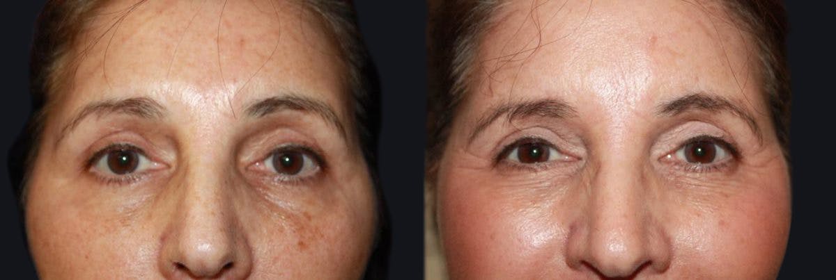 Laser Skin Rejuvenation Before & After Gallery - Patient 177905998 - Image 1