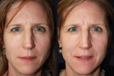 Laser Skin Rejuvenation Before & After Gallery - Patient 177905996 - Image 1