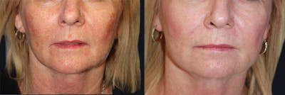 Laser Skin Rejuvenation Before & After Gallery - Patient 177905991 - Image 1