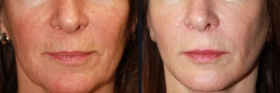 Laser Skin Rejuvenation Before & After Gallery - Patient 177905990 - Image 1