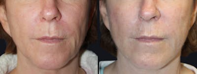 Laser Skin Rejuvenation Before & After Gallery - Patient 177905985 - Image 1