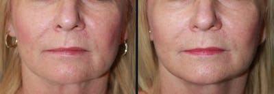Laser Skin Rejuvenation Before & After Gallery - Patient 177905984 - Image 1