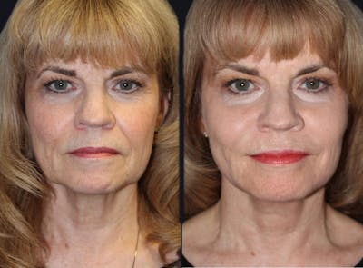 Laser Skin Rejuvenation Before & After Gallery - Patient 177905983 - Image 1