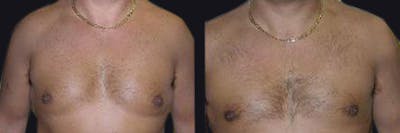 Male Liposuction Before & After Gallery - Patient 177905981 - Image 1