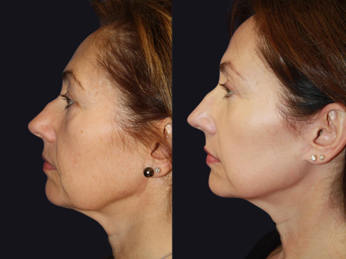 Laser Skin Rejuvenation Before & After Gallery - Patient 177905979 - Image 2